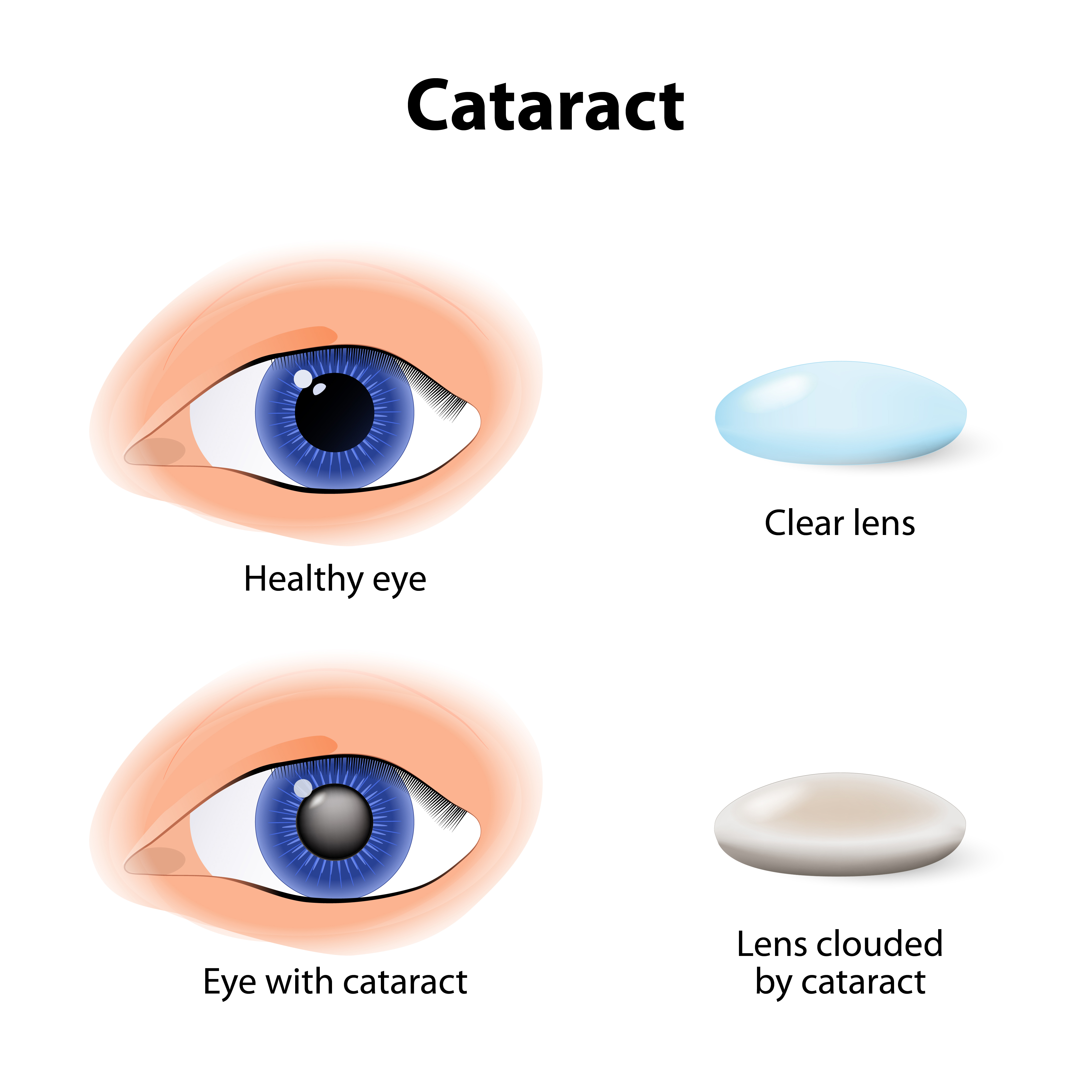 A cataract is an clouding crystalline lens